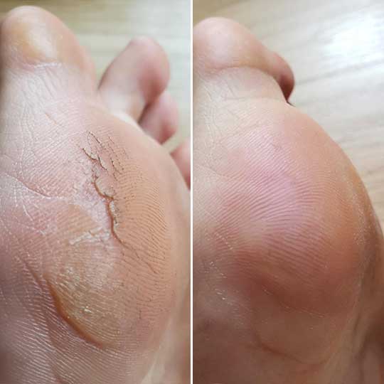 Mila Smooth™ 3 Pro – Vos pieds lisses en 2 minutes