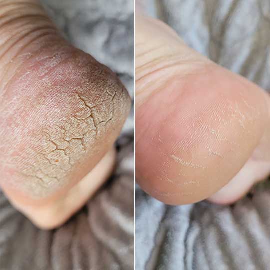 Mila Smooth™ 3 Pro – Vos pieds lisses en 5 minutes chrono