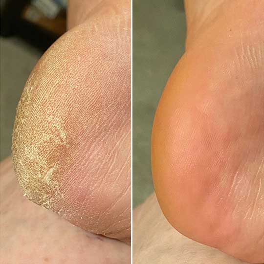 Mila Smooth™ 3 Pro – Vos pieds lisses en 5 minutes chrono